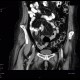 Thrombosis of femoral vein: CT - Computed tomography